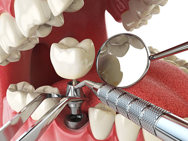 Best Emergency Root Canal Treatment in Milan, IN