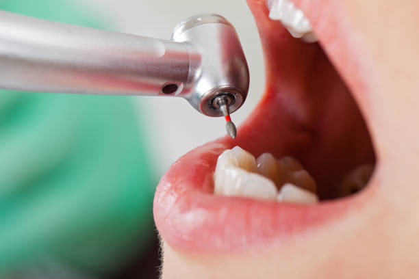 Best Emergency Dental Extractions in Milan, IN